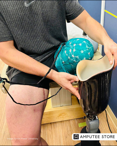 How AI and 3D Printing Are Improving Prosthetic Socket Fit