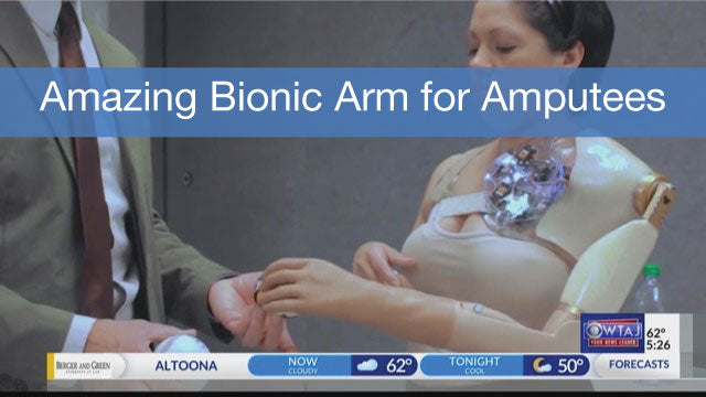 bionic hands and arms for upper extremity amputees