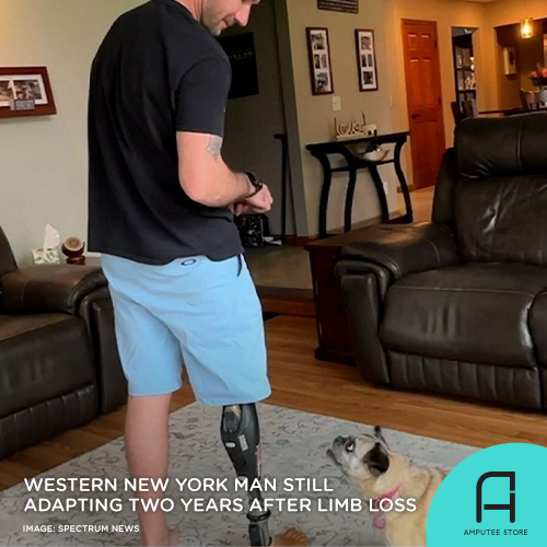 Man from Hamburg, New York finds that he's still adjusting to life without a leg two years after limb loss.