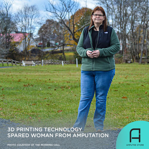 3D printing saved Rebecca Chopek from an amputation.