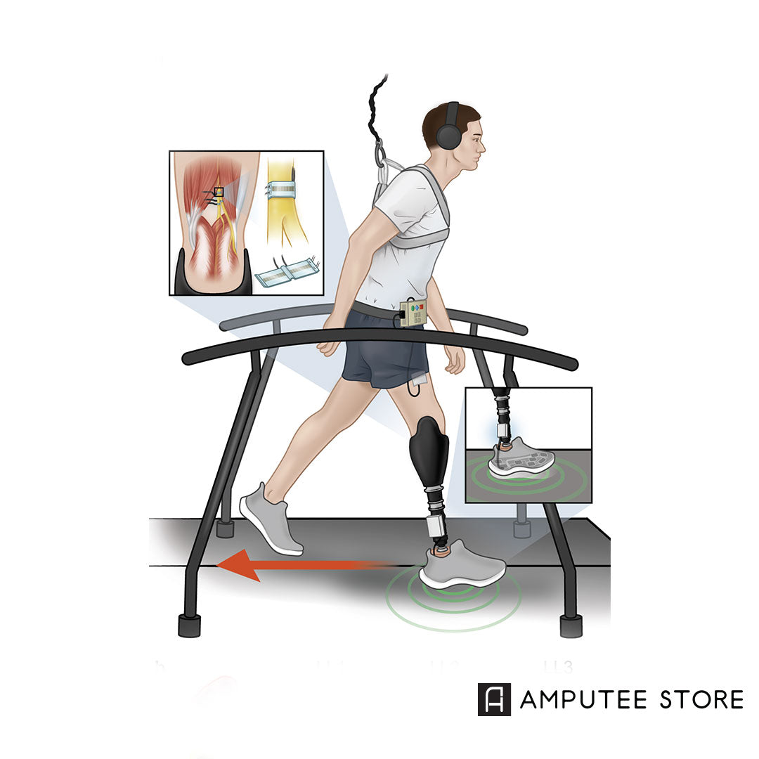 A new device called a sensory neuroprosthesis helps lower limb amputees recover from stumbling.