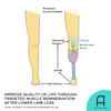 Targeted Muscle Reinnervation could help improve pain after lower limb loss.