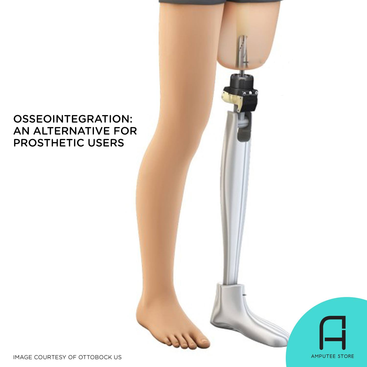 Osseointegration: An Alternative for Prosthetic Users