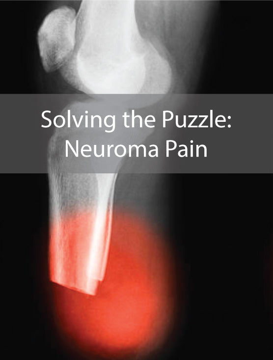 Neuroma pain can make wearing a prosthesis very difficult to wear.