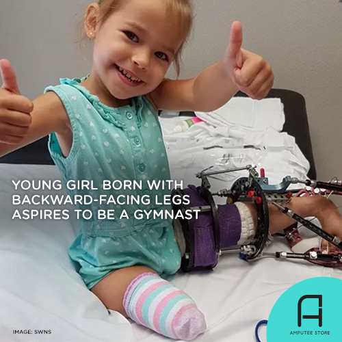 Young girl born with backward facing legs aspires to be a gymnast.